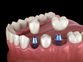 Premolar and Molar tooth crown installation over implant abutments. Medically accurate 3D...