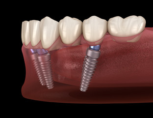 Mandibular prosthesis All on 4 system supported by implants. Medically accurate 3D illustration of...