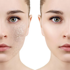 Young woman with dehydrated skin before and after treatment.