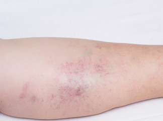 Female leg on a white background with red capillary vessels, varicose veins on the legs of an elderly woman, close-up, white background, phlebeurysm, medical
