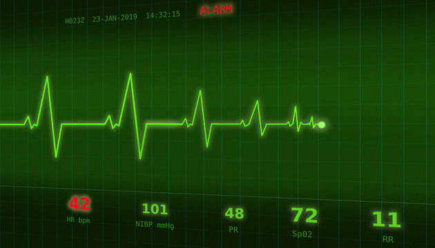 Graph of abnormal heartbeat on a green monitor with an ALARM signal