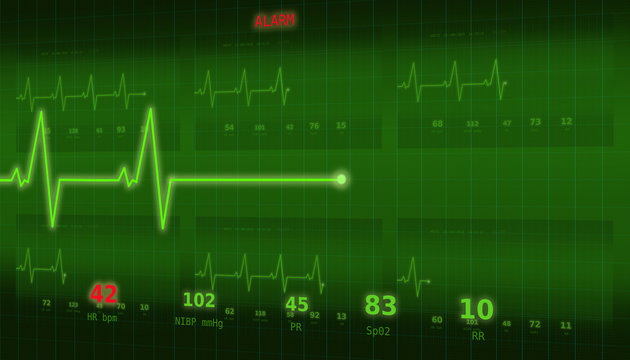 Graph of abnormal heartbeat on a green monitor with an ALARM signal