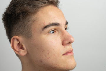 The teen with pimples and acne on face