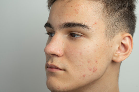 a teenager cleans his face with a remedy to get rid of acne and blackheads