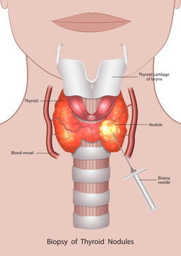 Fluid removal from the thyroid gland with a biopsy needle