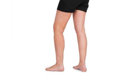 Varicose veins on a female legs