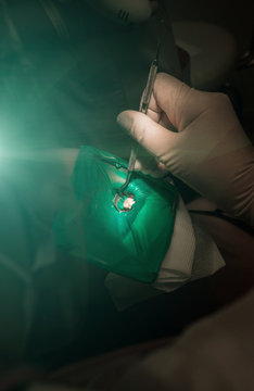 treatment of tooth caries, dental  close-up.