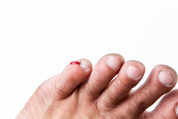 The little finger of foot is a wound and bleeding isolated on white background.