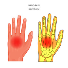 Vector illustration of unhealthy human hand with pain. Bony anatomy of the hand and wrist. Dorsal view of the hand isolated on white background. For advertising and other medical publications