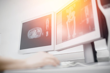 Magnetic resonance imaging. Patient MRI scan resultst open on computer screen, Doctor analyzes....