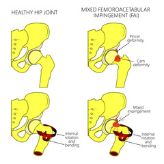 Vector illustration of a healthy human hip joint and a hip with mixed femoroacetabular impingement. Front view of hip joint with section of the pelvis. For advertising and medical publications.