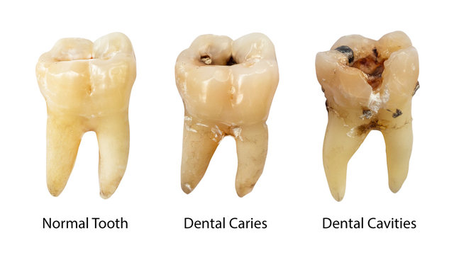 Normal tooth , Dental caries and Dental cavity with calculus . Comparison between difference of teeth decay stages . White isolated background . Front side view