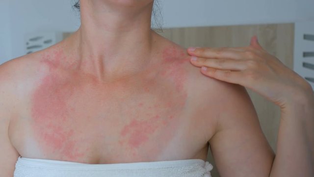 Woman scratch the itch with hand, Neck. Red spots on the neck, allergies, psoriasis, insect bite. Malaria. Sunburn. Sun burn