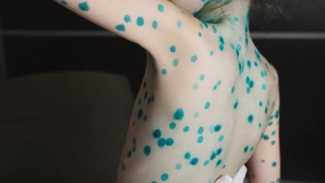 Woman doctor examining the back of a little girl sick with pox.