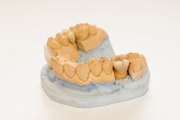 Dental gypsum model in dentist laboratory office - close-up.  Gypsum Dentures with porcelain teeth isolated on white background - copy space