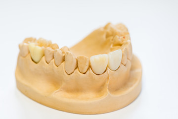 Dental gypsum model in dentist laboratory office - close-up.  Gypsum Dentures with porcelain teeth isolated on white background - copy space