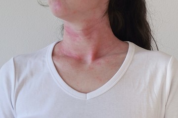 Allergic skin reaction on the female neck and face