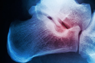 Medical background x-ray of ankle. Closeup pain spot indicated with red color.