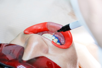 Patient with safety protective glasses and cheek retractor on. Laser light lamp turn on as a...