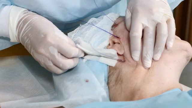 Aged female patient in surgery getting face contour procedure to eliminate signs of aging. Closeup shot of surgeon hands making thread lifting. 4k