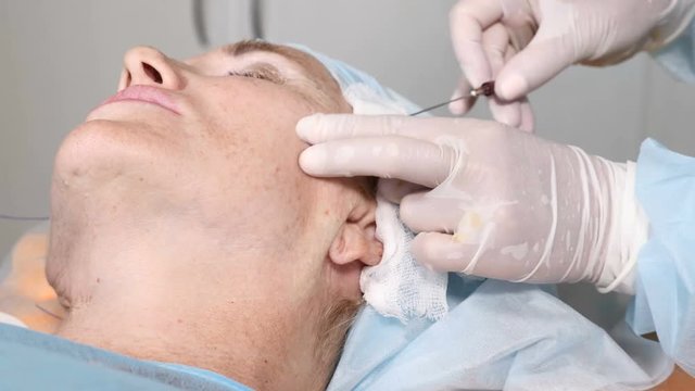 Senior woman in beauty healthcare clinic. Sergeon in gloves making thread lifting procedure for face skin to hide age. Face contour. 4k