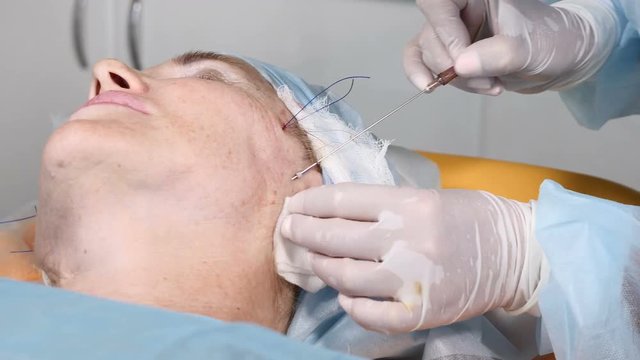 Beauty surgical operation to hide signs of aging. Flaccid face skin uplifting. Face contour. Aged woman in her 50s getting face contour procedure with medical threads. 4k