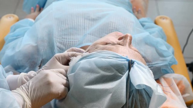 Beauty surgical operation to hide signs of aging. Flaccid face skin uplifting. Face contour. Aged woman in her 50s getting face contour procedure with medical threads. Top view. 4k