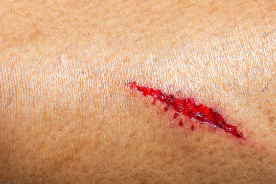 Closeup deep wounds from sharp objects on human skin.