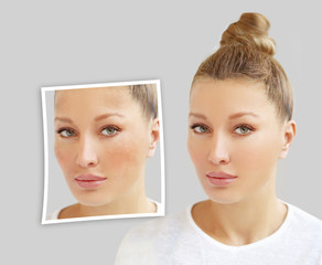 Dark spots, freckles,hyperpigmentation(melasma or chloasma)