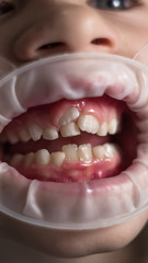 Adult permanent teeth coming in front of the child's baby teeth: shark teeth.