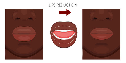 Vector illustration. African American Lips reduction before and after procedure. Close up view. For advertising of medicinal, pharmacy products, cream, lotion, cosmetic and plastic procedures