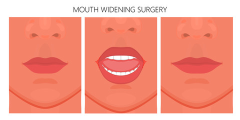 Vector illustration. Mouth widening surgery on face before, after procedure. Close up view. For advertising of medicinal, cosmetic, plastic surgery, procedures