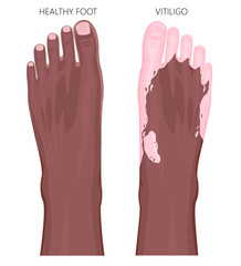 Vector illustration of a healthy Afro American foot and a foot with vitiligo, loss of skin color. Dorsal view.  For advertising, medical publications
