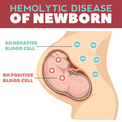 Hemolytic disease of newborn infographics. Detailed vector Infographic. Baby Health