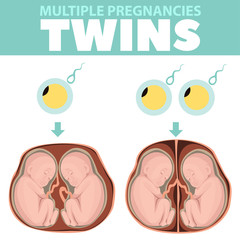 Variants of cell division under twins. Infographics. Detailed vector Infographic. Baby Health