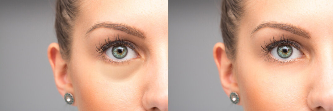 Eyes before and after elimination of swelling