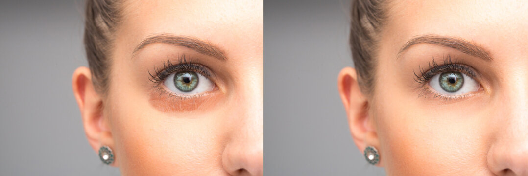 Puffiness under eyes removal before and after treatment