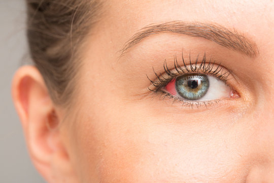 Red spot in eye sclera
