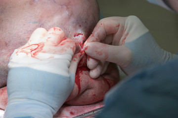Surgeon connects tissue expander to a tube after the setting under the head skin during the head tumor operation