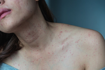 Skin Allergy Symptoms of patient,Allergic skin reaction on the female neck and chest.Health problem