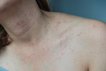 Fototapeta premium Skin Allergy Symptoms of patient,Allergic skin reaction on the female neck and chest.Health problem