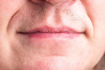 Real female mustache. Signs of male hormones on female face. 