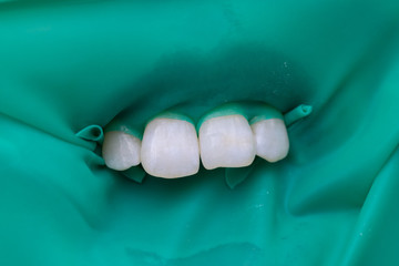 Close-up latex plate designed to isolate the tooth to be treated from the rest of the oral cavity during treatment. Dentist prepared the front teeth for treatment.