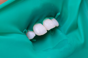Close-up latex plate designed to isolate the tooth to be treated from the rest of the oral cavity during treatment. Dentist prepared the front teeth for treatment.