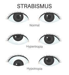 Types of strabismus - Hypertropia and Hypotropia
