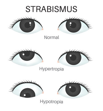 Download Strabismus Photos Royalty Free Images Graphics Vectors Videos Adobe Stock