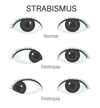 Types of strabismus- Esotropia and Exotropia