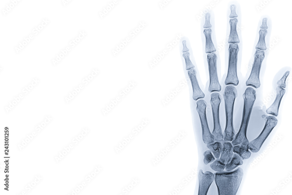 Poster x-ray image of left hand isolated on white background with copy space and background.
