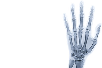 X-ray image of left hand isolated on white background with copy space and background.