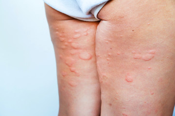 Skin rash in the legs